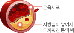 근육세포, 지방질이 쌓여서 두꺼워진 동맥 벽 이미지